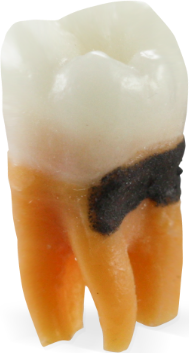 Perio Replacement Teeth with SimCalc&trade;