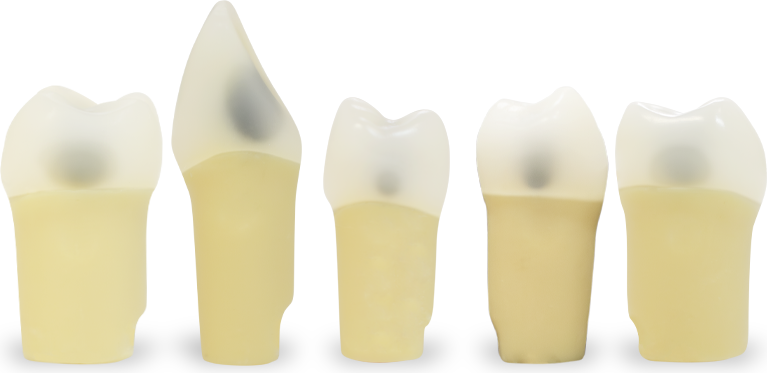 Prime Caries Teeth (PCT)
