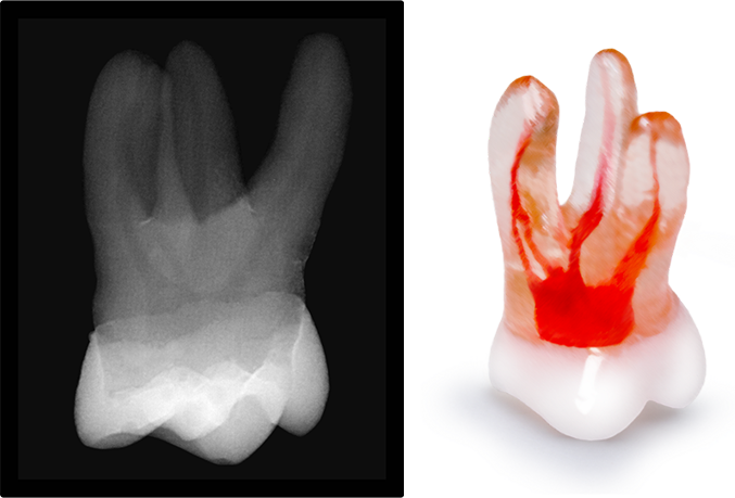Radiograph Like a Natural Tooth